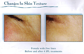 Chicago Laser Skin Tightening